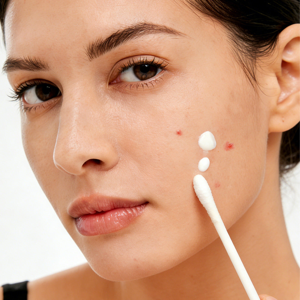 Acne Drying Lotion with Encapsulated Salicylic Acid, Sulfur and Niacinamide