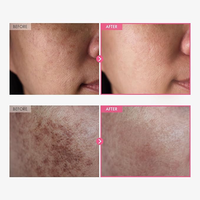 Arbutin 7% and Tranexamic Acid 4% Cream with Niacinamide and Glutathione for Dark Spots