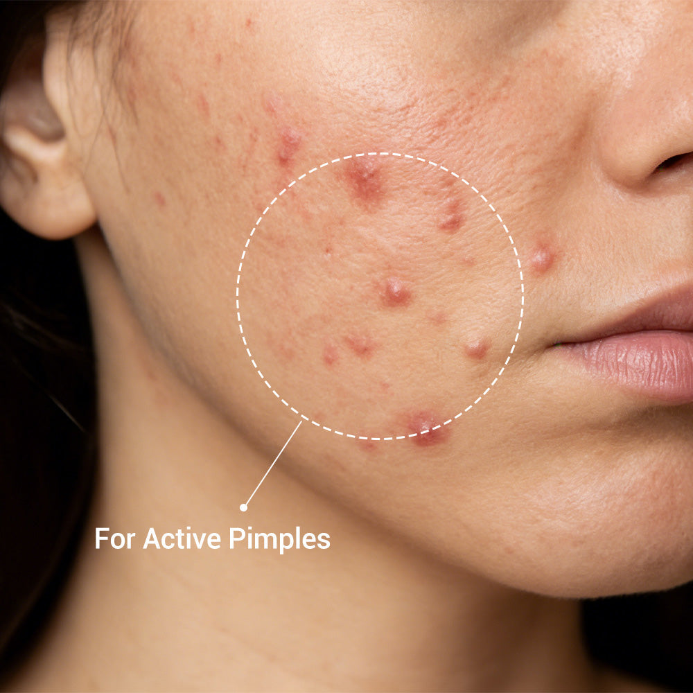 Acne Drying Lotion with Encapsulated Salicylic Acid, Sulfur and Niacinamide