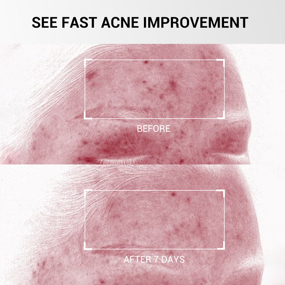 Acne Drying Lotion with Encapsulated Salicylic Acid, Sulfur and Niacinamide
