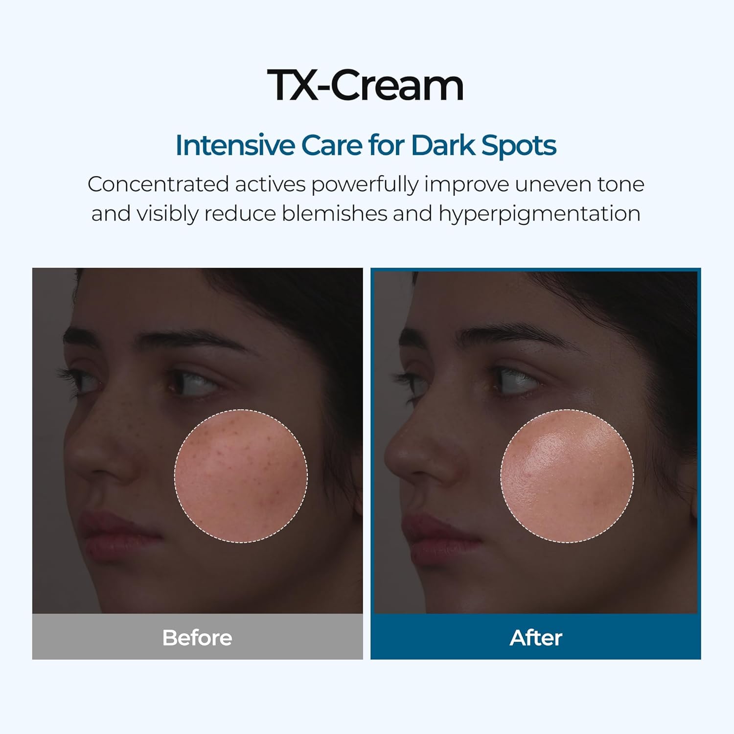 TX Tranexamic Acid Cream for Dark Spots, Hyperpigmentation and Uneven Tone