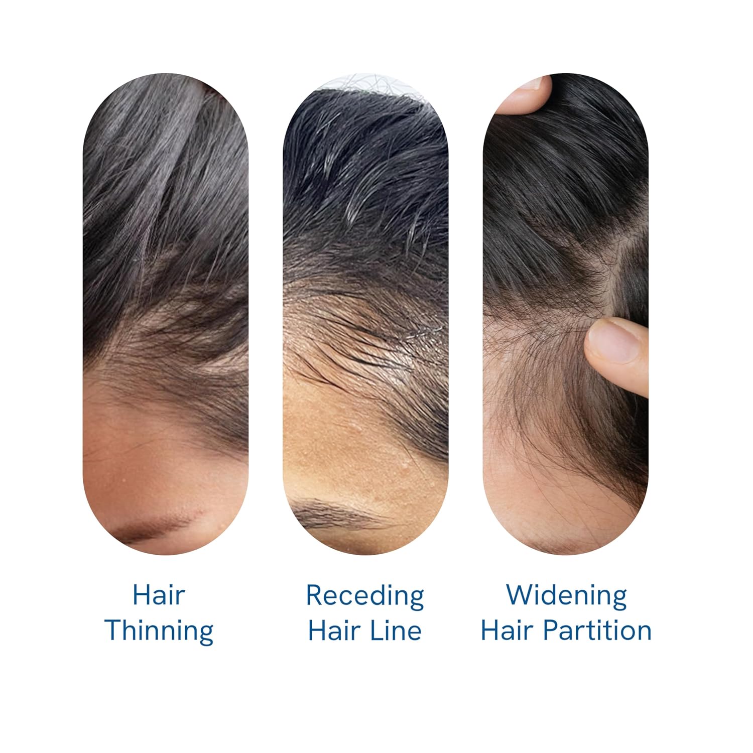 Advanced Hair Growth Roll-On Serum with Rosemary Oil, Redenex and Anaflex